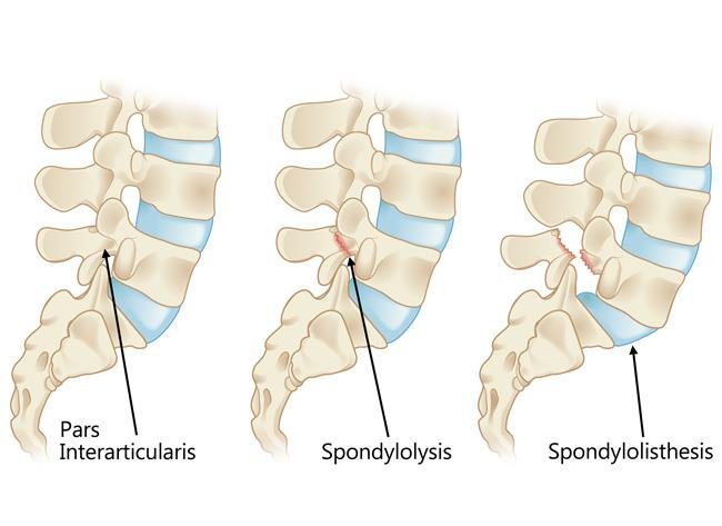 Human lumbar spine-spondylolisthesis