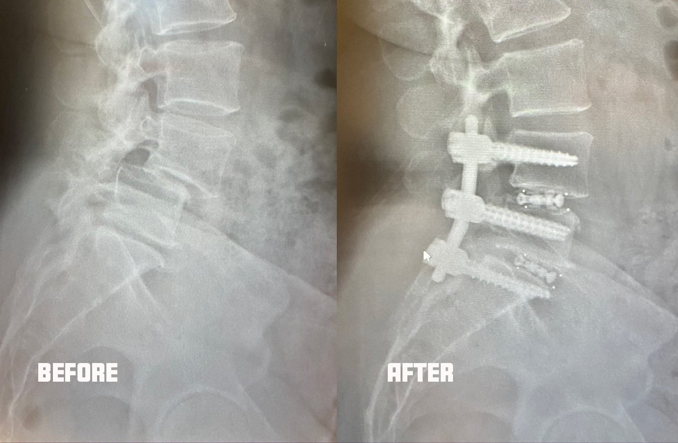 Katie's x-rays before and after